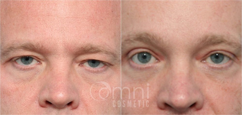 0001_OmniCosmetic_Wayzata_face_foreheadlift_B&A_Patient1_front