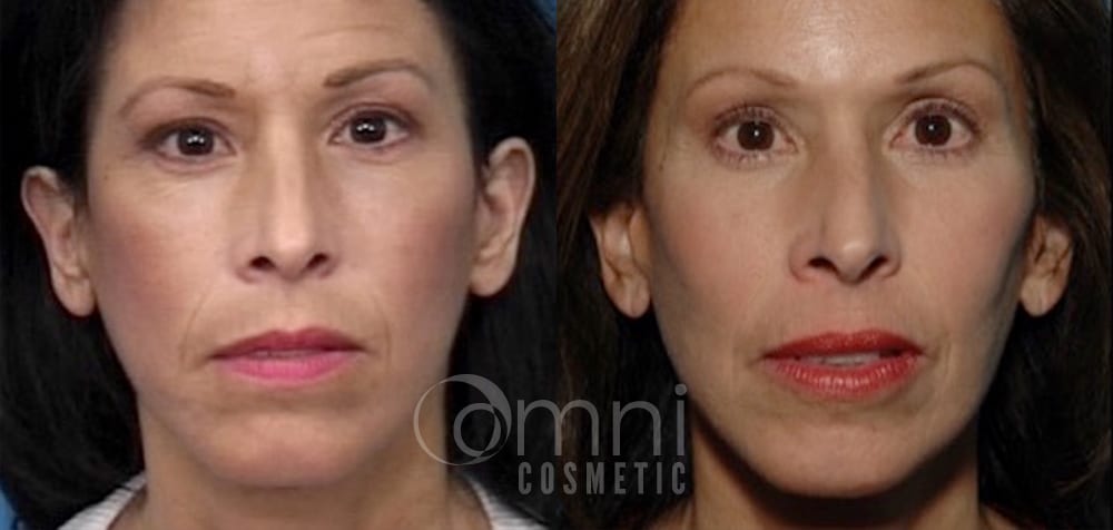 OmniCosmetic_Cheek_Implant_B&A_Patient 1_Front