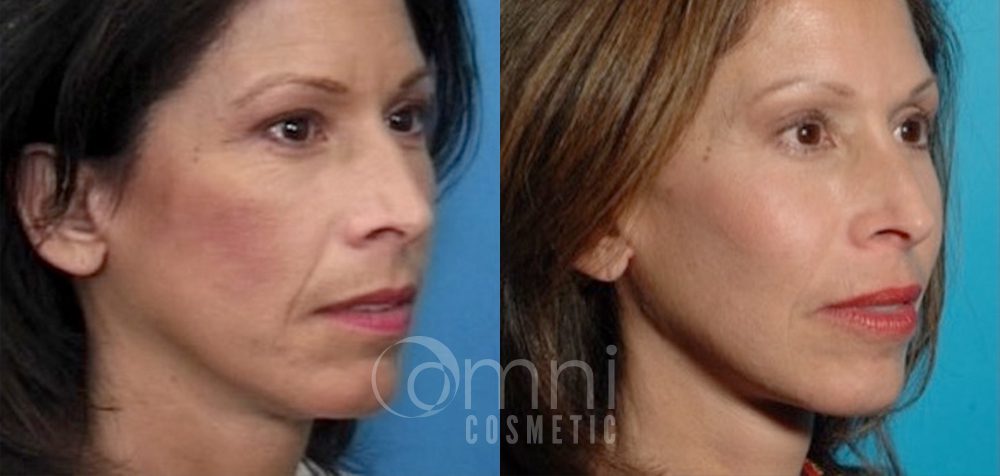 OmniCosmetic_Cheek_Implant_B&A_Patient 1_Side