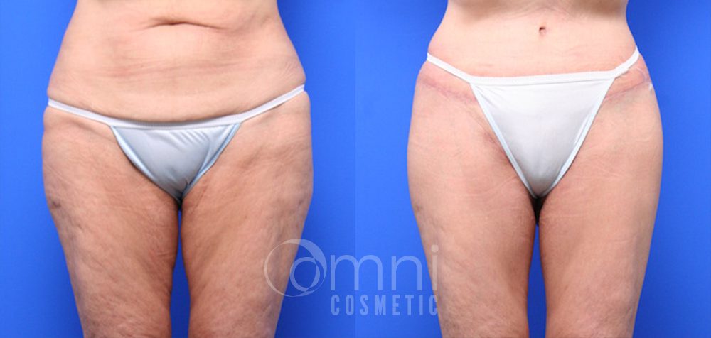 OmniCosmetic_Lower_Bodylift_B&A_Patient 3_Front