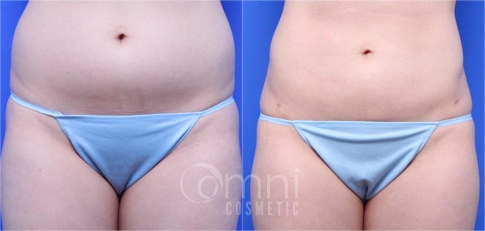 OmniCosmetic_Wayzata_body_liposuction_B&A_Patient6_front