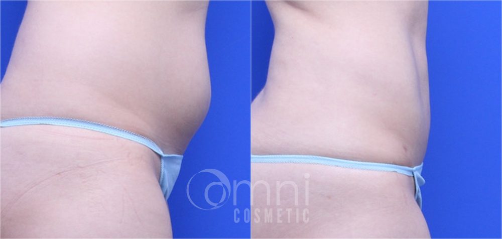 OmniCosmetic_Wayzata_body_liposuction_B&A_Patient6_side