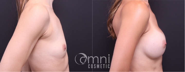 Before and after ballerina breast augmentation.