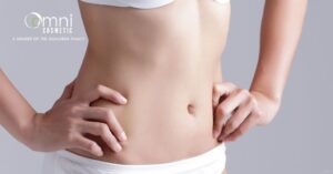 Woman showing off her tummy tuck results (model)